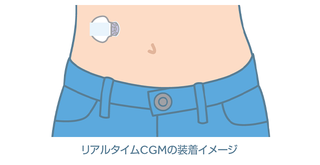 リアルタイムCGMとは？